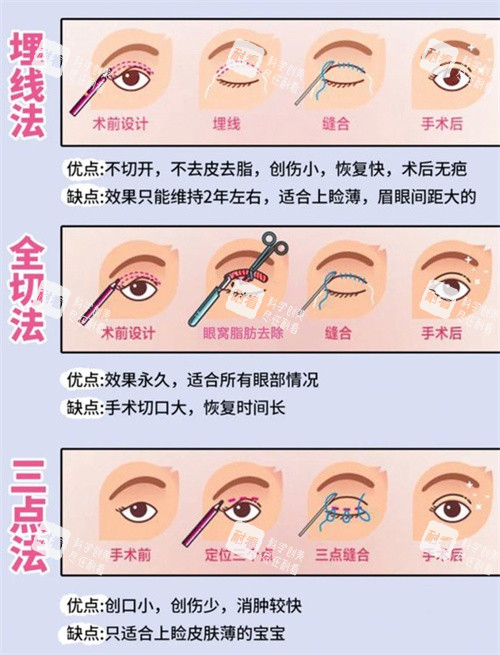 雙眼皮三種手術(shù)方式動畫 雙眼皮三種手術(shù)方式動畫