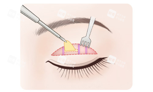 全切雙眼皮脂肪切除 全切雙眼皮脂肪切除
