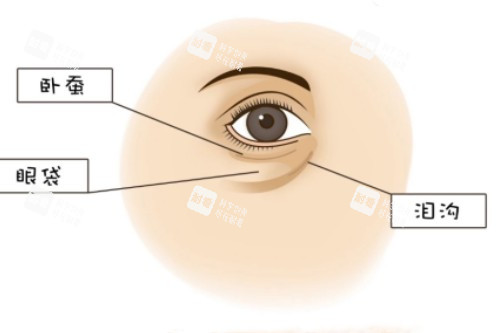 臥蠶、眼袋、淚溝展示圖