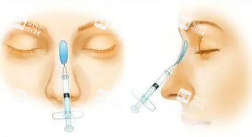 瑞婭玻尿酸注射示意圖