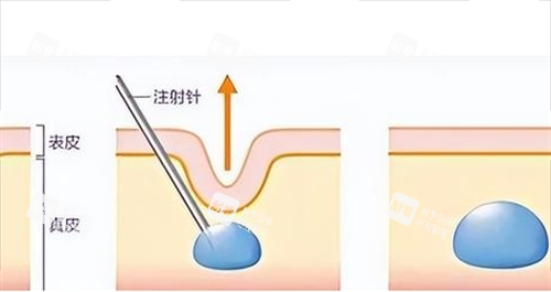 玻尿酸注射皮膚前后對比