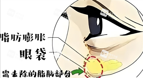 脂肪膨脹性眼袋需要去除的部分