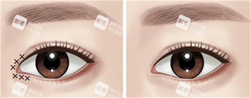 開眼角手術(shù)前后對比圖