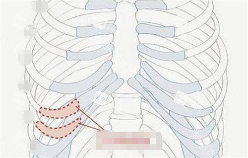 肋軟骨隆鼻肋部位置展示圖 肋軟骨隆鼻肋部位置展示圖