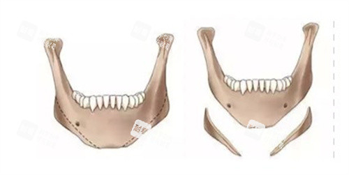 下頜角成角截骨術(shù)