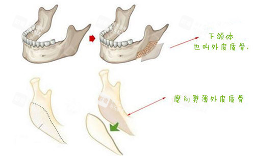 下頜角皮質(zhì)骨截骨手術(shù)圖片