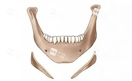 下頜角長(zhǎng)曲線截骨示意圖