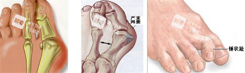 大腳骨的表現(xiàn) 大腳骨的表現(xiàn)
