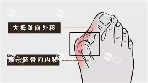大腳骨的癥狀 大腳骨的癥狀