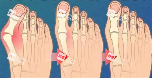 不同程度的大腳骨 不同程度的大腳骨