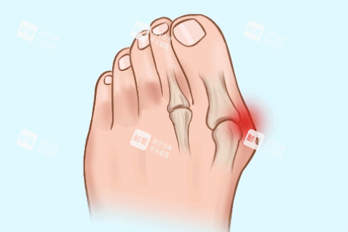 大腳骨疼痛卡通圖 大腳骨疼痛卡通圖