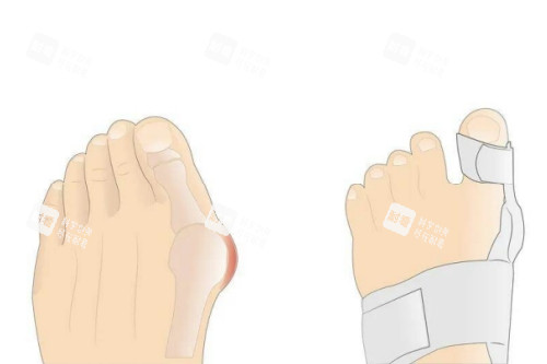 大腳骨矯正卡通圖 大腳骨矯正卡通圖