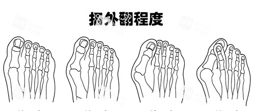 大腳骨外翻程度 大腳骨外翻程度