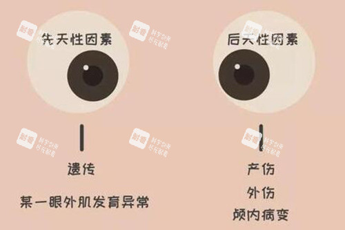 斜視眼睛照片圖