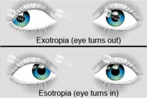 內(nèi)外斜視
