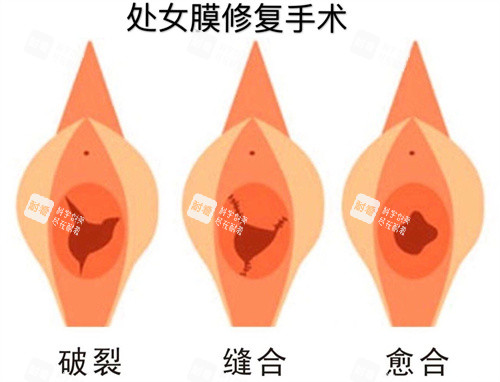 處女膜修復(fù)手術(shù)過(guò)程動(dòng)畫(huà)演示圖 處女膜修復(fù)手術(shù)過(guò)程動(dòng)畫(huà)演示圖