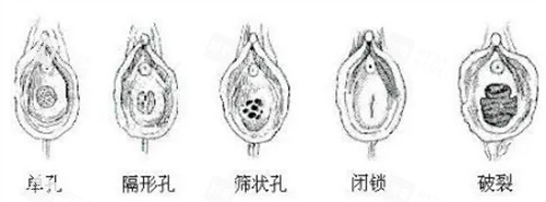 不同形狀的處女膜 不同形狀的處女膜