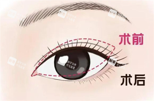雙眼皮修復(fù)手術(shù)對比 雙眼皮修復(fù)手術(shù)對比