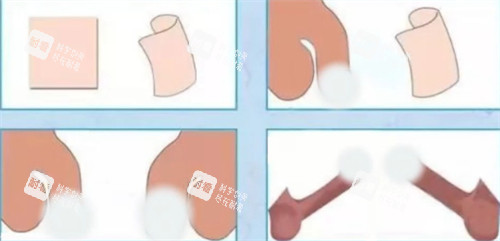 陰莖生物補(bǔ)片手術(shù)前后對(duì)比