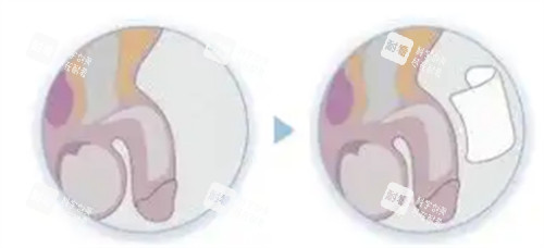 陰莖生物補(bǔ)片手術(shù)過(guò)程介紹