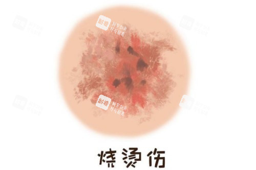 皮膚燙傷疤卡通圖
