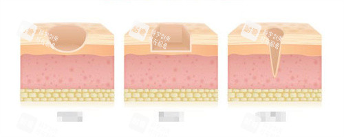 三種不同類型的疤痕