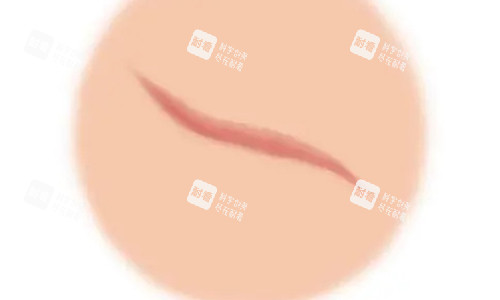 疤痕增生的不同動(dòng)畫展示圖