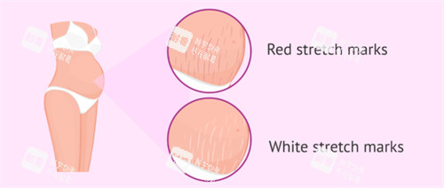 妊娠紋疤痕漫畫圖疤痕