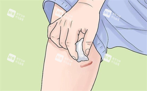 疤痕疙瘩怎么護(hù)理