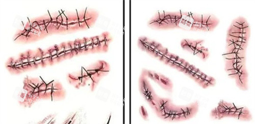不同的手術(shù)疤痕