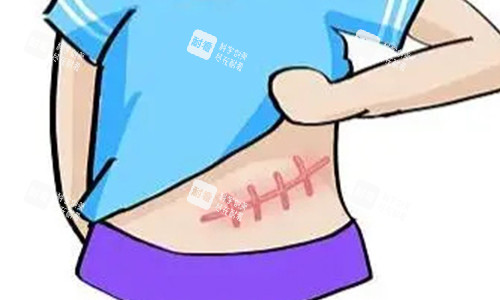 腹部疤痕增生的動(dòng)畫圖