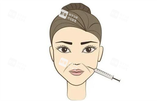 除皺針注射圖