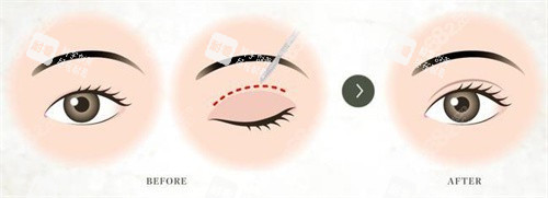 雙眼皮術(shù)對比宣傳圖