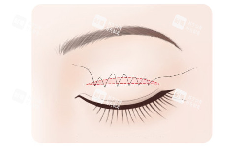 全切雙眼皮縫合