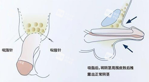 吸脂增大陰莖照片