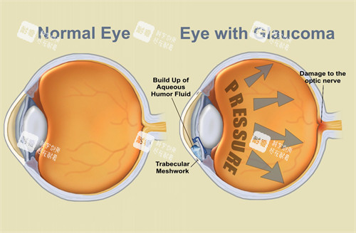 青光眼治療圖示