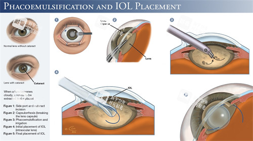 超聲乳化白內(nèi)障手術細節(jié)圖