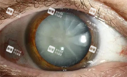 白內(nèi)障眼球照片