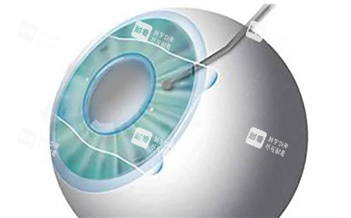 ICL晶體植入示意圖