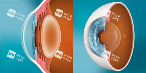 ICL晶體植入前后對比