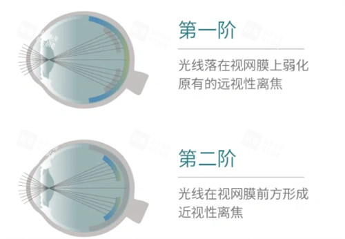 思問子夏離焦眼鏡矯正過程