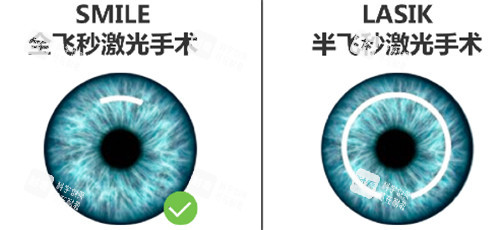 半飛秒和全飛秒手術區(qū)別圖