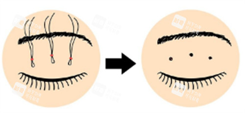 皮下速接雙眼皮操作過(guò)程圖解