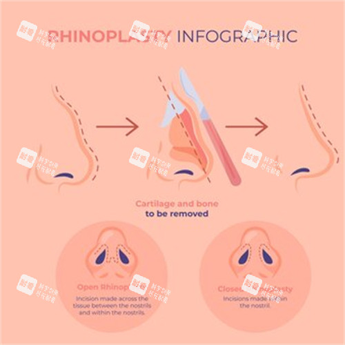 鼻整形過程 鼻整形過程