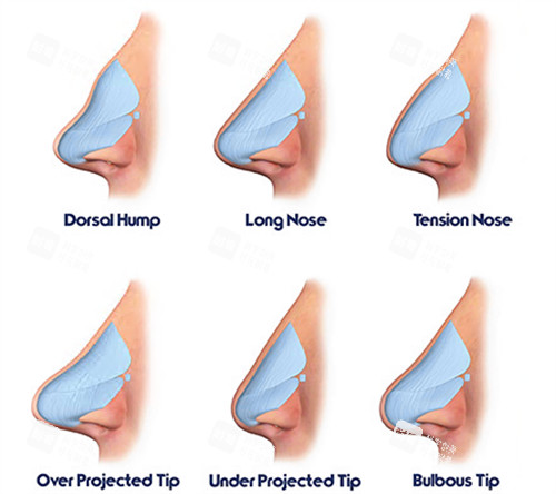 鼻部整形動畫演示圖 鼻部整形動畫演示圖
