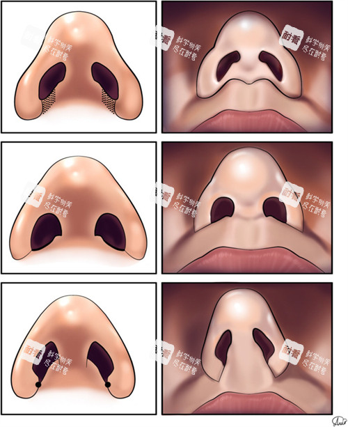 鼻整形的對比 鼻整形的對比