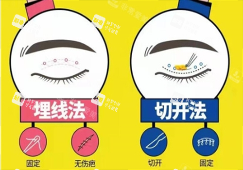 雙眼皮埋線和切開對比圖