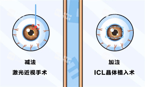 近視手術(shù)的分類