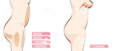 自體脂肪隆胸圖