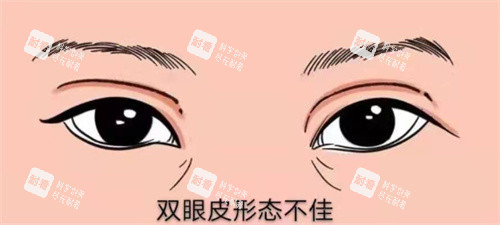 雙眼皮修復示圖